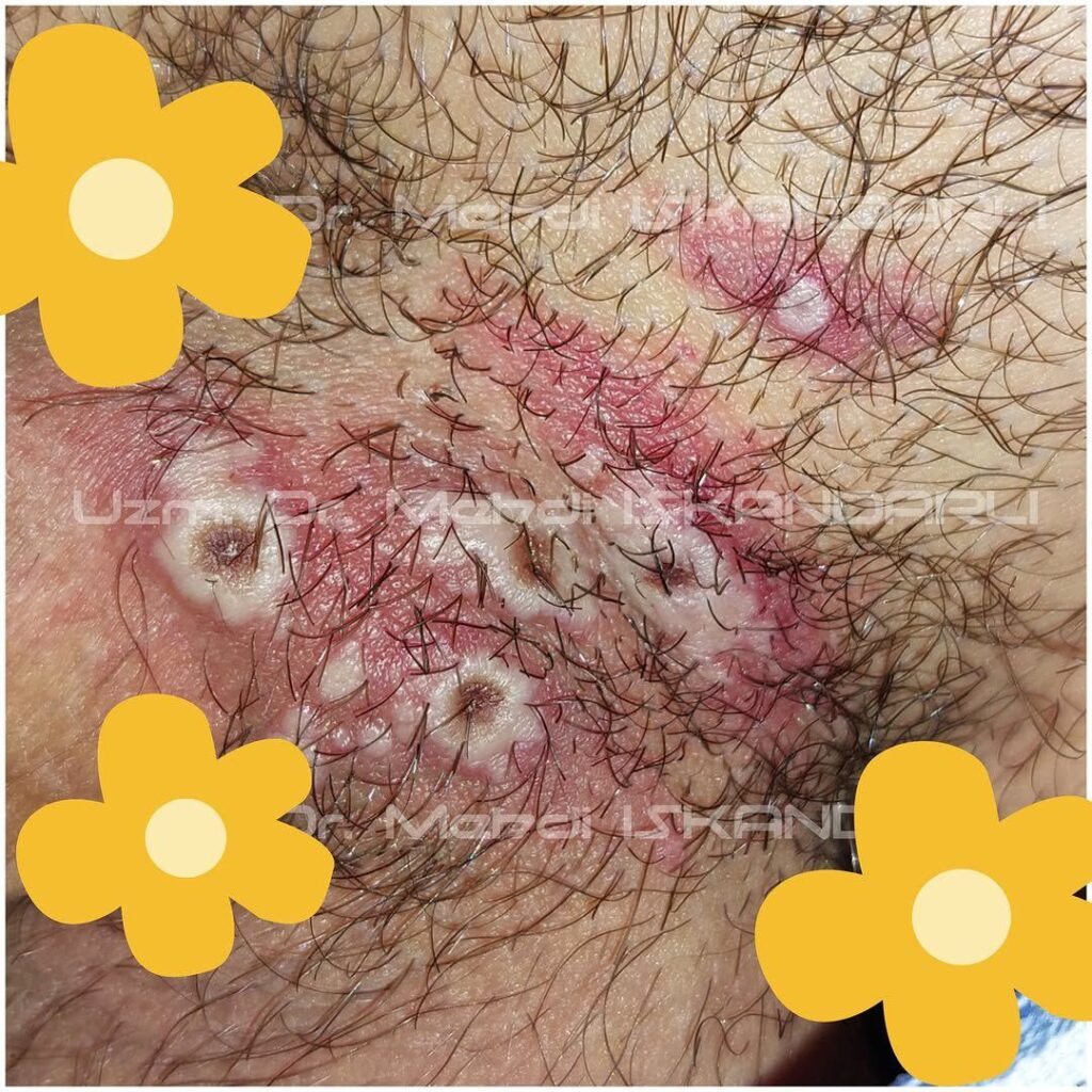 Azərbaycanda ilk meymunçiçəyi diaqnozu qoyan həkimdən PAYLAŞIM