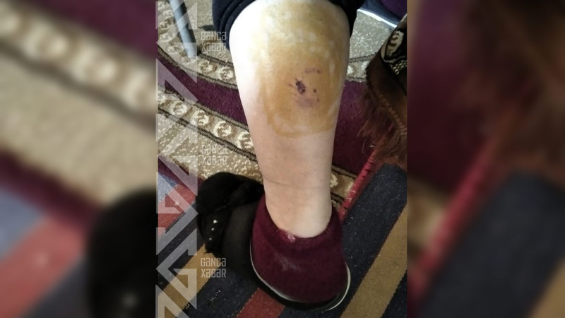 Gəncədə ortayaşlı xanım itlərin hücumundan sonra xəsarət alıb
