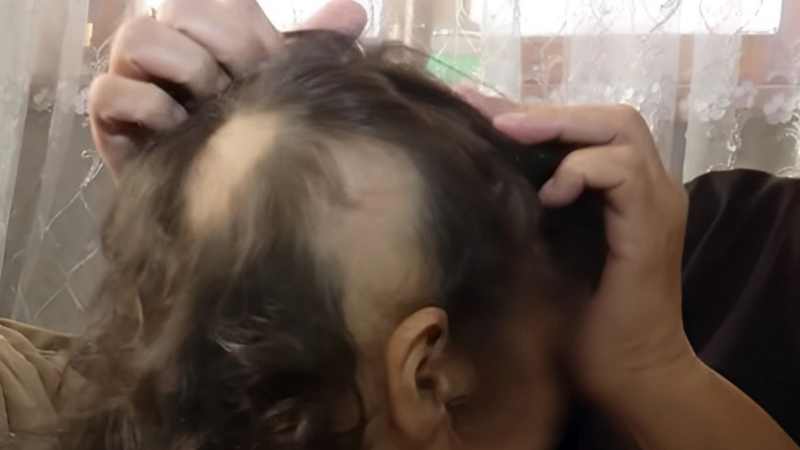 Azyaşlının qurd müalicəsi saçlarını tökdü