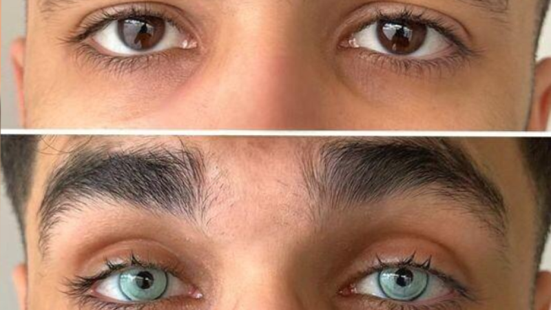 Oftalmoloq: “Göz rəngini dəyişən pasiyent hər şeyi həmin rəngdə görəcək” – AÇIQLAMA