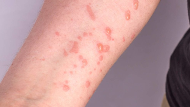 Azərbaycanda meymunçiçəyi ilə bağlı rəsmi AÇIQLAMA