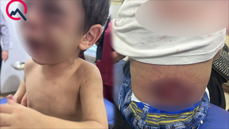 2 yaşlı qızına siqaretlə DAĞ BASAN ögey ata həbs edildi - YENİLƏNİB