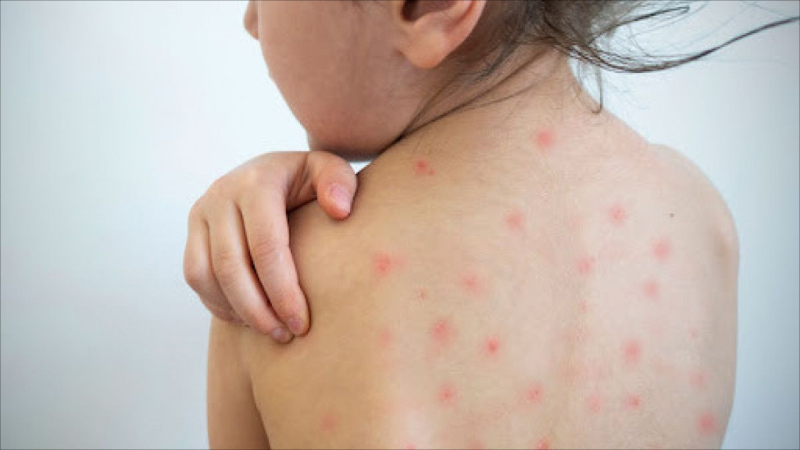 Nazirlik suçiçəyinə yoluxma ilə bağlı vəziyyəti açıqlayıb