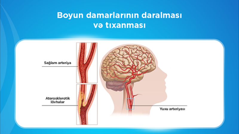 Bu müalicə də icbari tibbi sığortaya daxildir