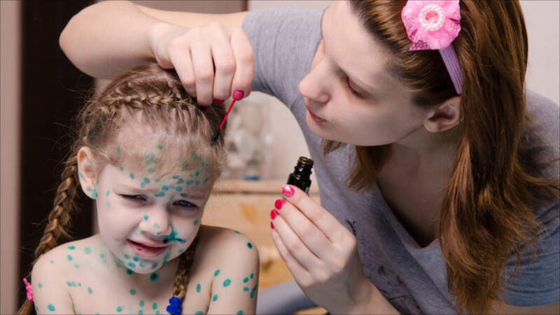 Azərbaycanda uşaqlar arasında suçiçəyi yayılıb