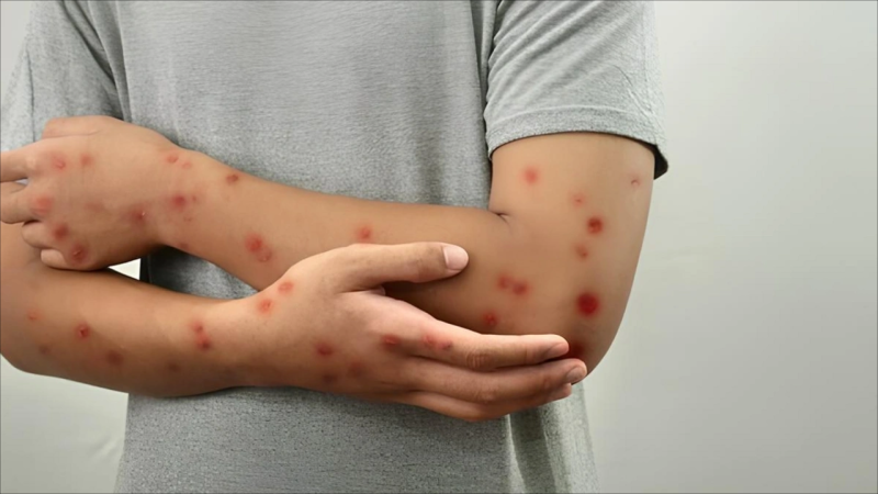 Meymunçiçəyinə yoluxan şəxs evə buraxılıb