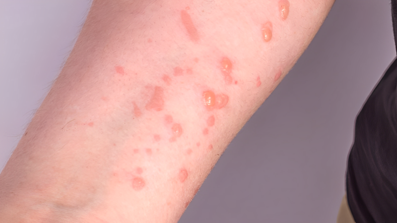 Azərbaycanda bir nəfərdə meymunçiçəyi virusu aşkarlanıb - RƏSMİ