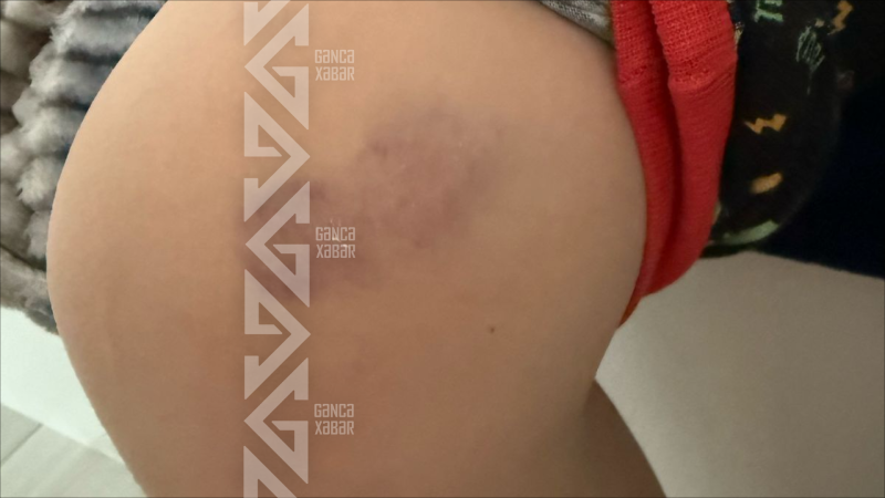 Gəncədə məktəblinin xəsarət alması ilə bağlı araşdırma aparılır - YENİLƏNİB