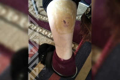 Gəncədə ortayaşlı xanım itlərin hücumundan sonra xəsarət alıb