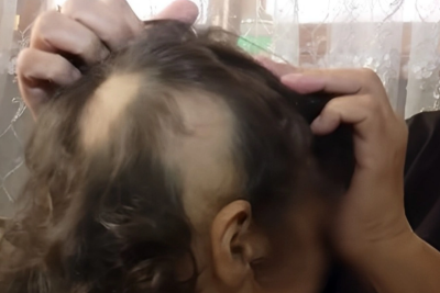 Azyaşlının qurd müalicəsi saçlarını tökdü