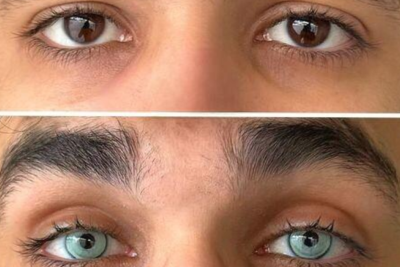 Oftalmoloq: “Göz rəngini dəyişən pasiyent hər şeyi həmin rəngdə görəcək” – AÇIQLAMA