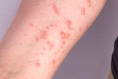 Azərbaycanda meymunçiçəyi ilə bağlı rəsmi AÇIQLAMA