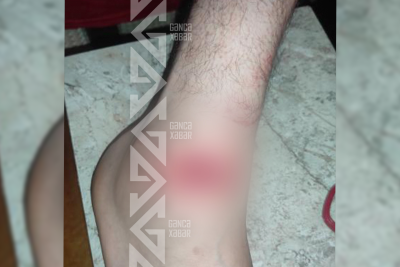 Gəncədə it sürüsü 4 nəfərə xəsarət yetirib