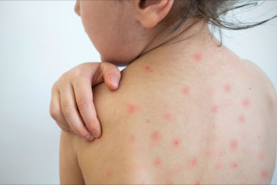 Nazirlik suçiçəyinə yoluxma ilə bağlı vəziyyəti açıqlayıb