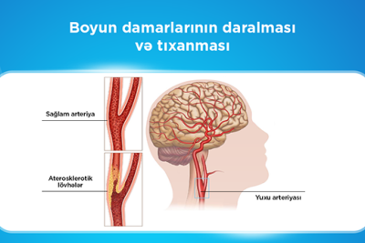 Bu müalicə də icbari tibbi sığortaya daxildir