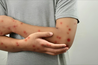 Meymunçiçəyinə yoluxan şəxs evə buraxılıb