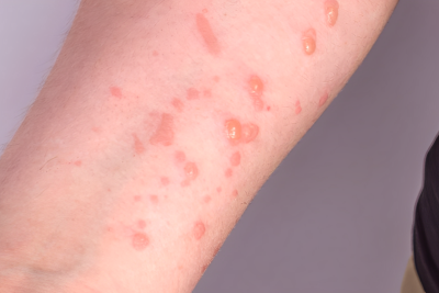 Azərbaycanda bir nəfərdə meymunçiçəyi virusu aşkarlanıb - RƏSMİ