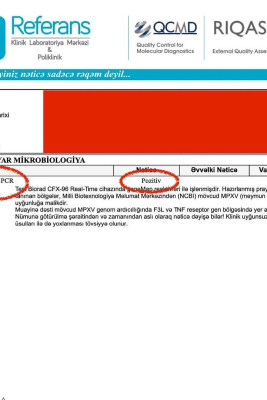 Azərbaycanda ilk meymunçiçəyi diaqnozu qoyan həkimdən PAYLAŞIM - FOTO