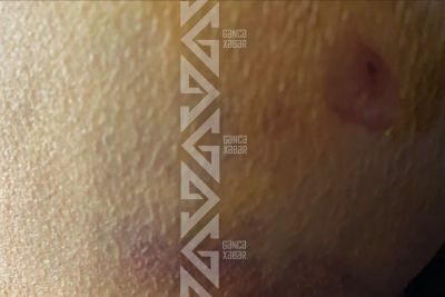 Gəncədə 70 yaşlı qadını it dişlədi - FOTO